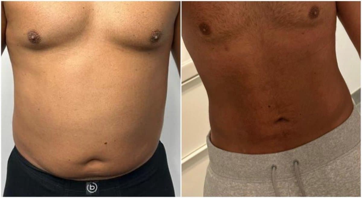 liposuction