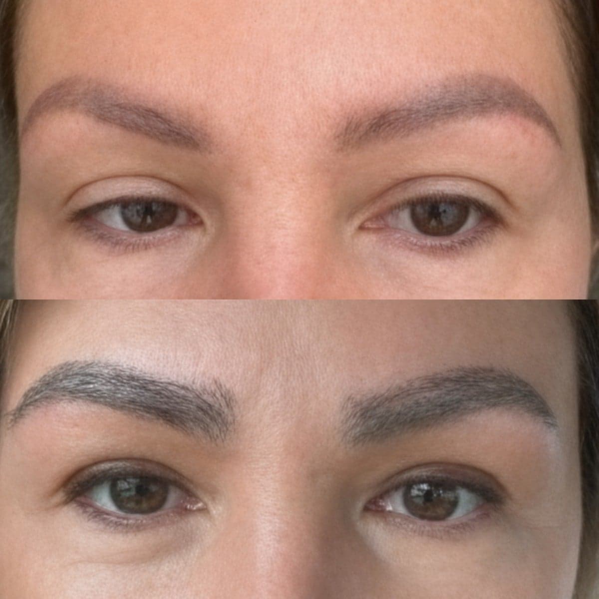 eyebrow transplantation