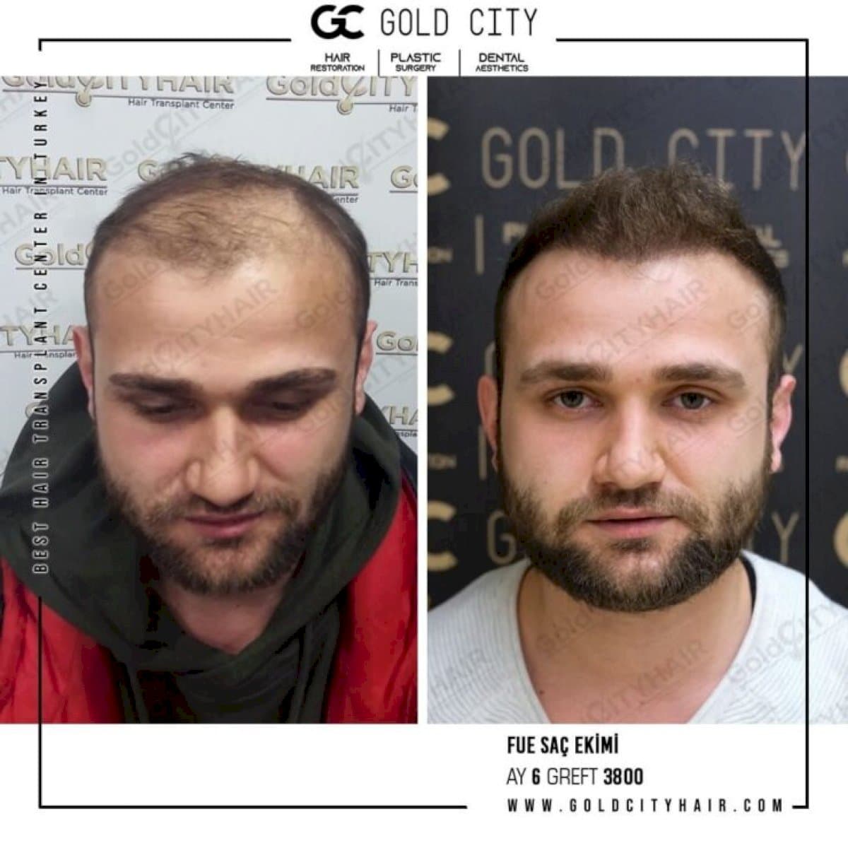 FUE hair transplant