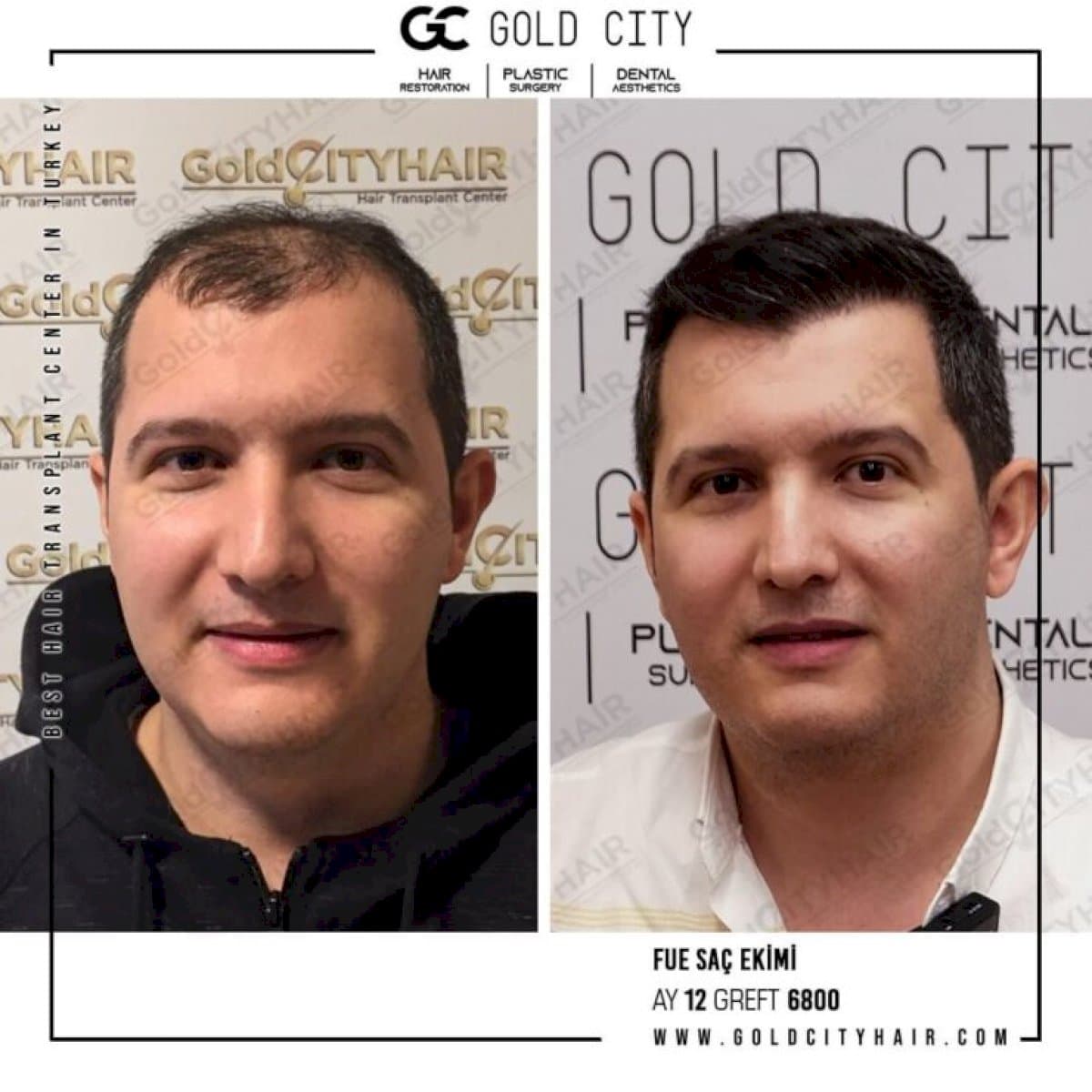 FUE hair transplant