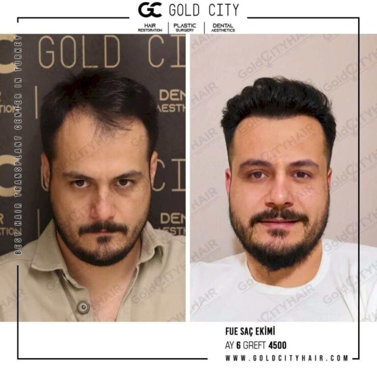 FUE hair transplant