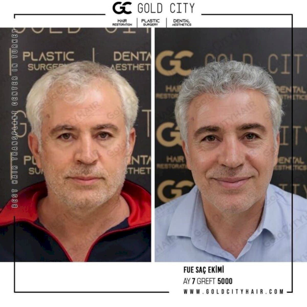 FUE hair transplant