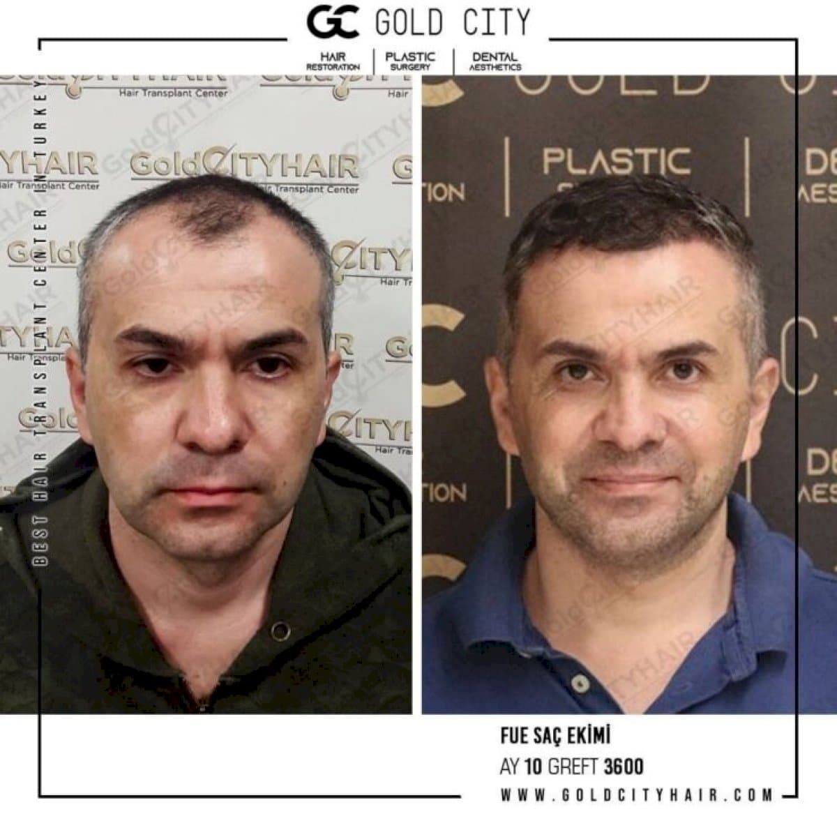 FUE hair transplant