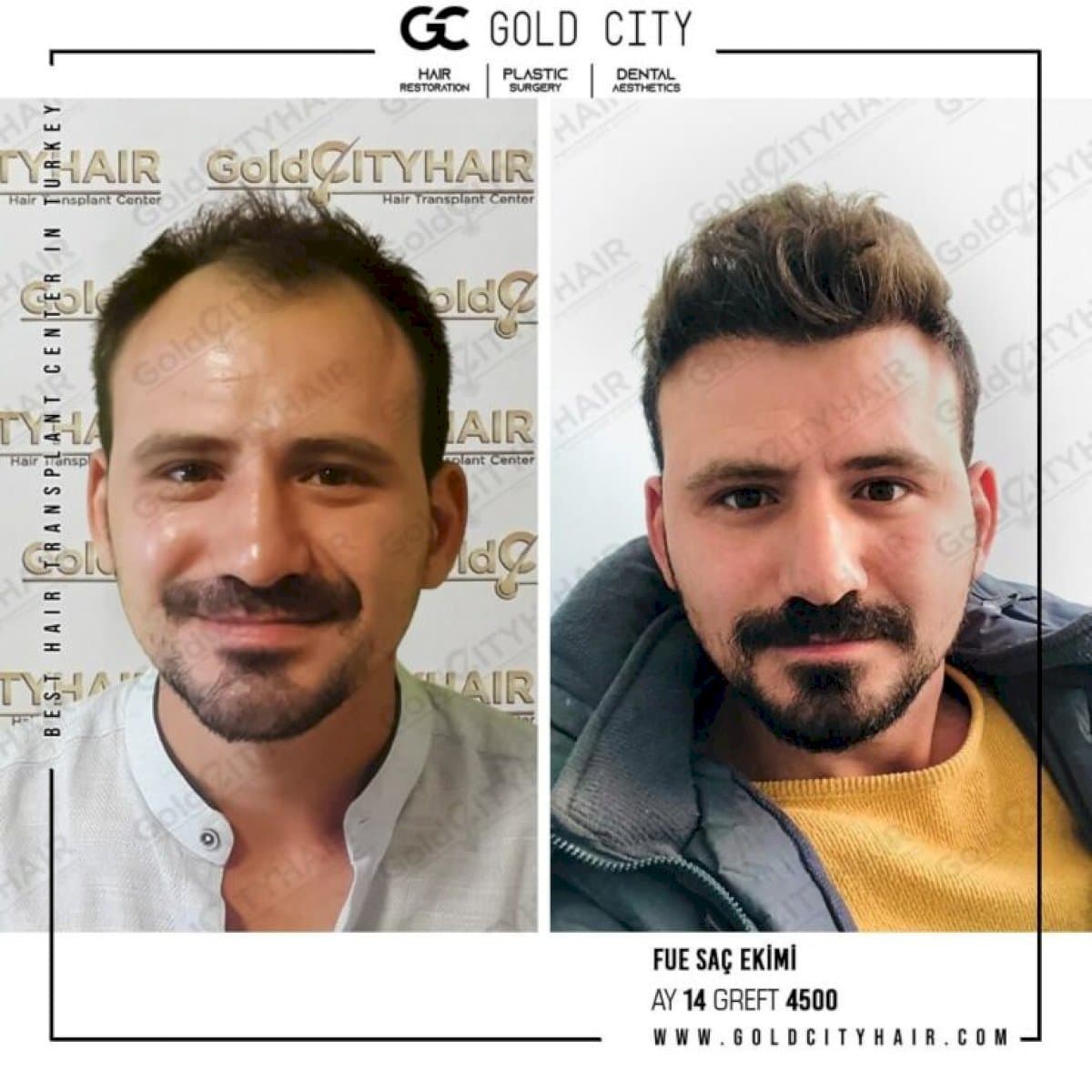 FUE hair transplant