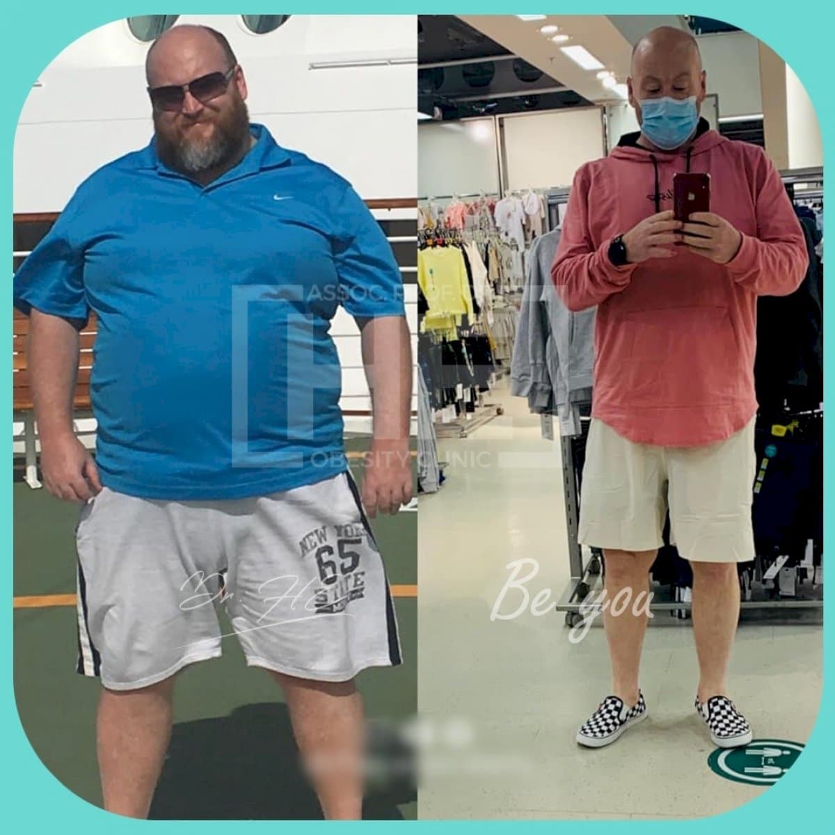 gastric band