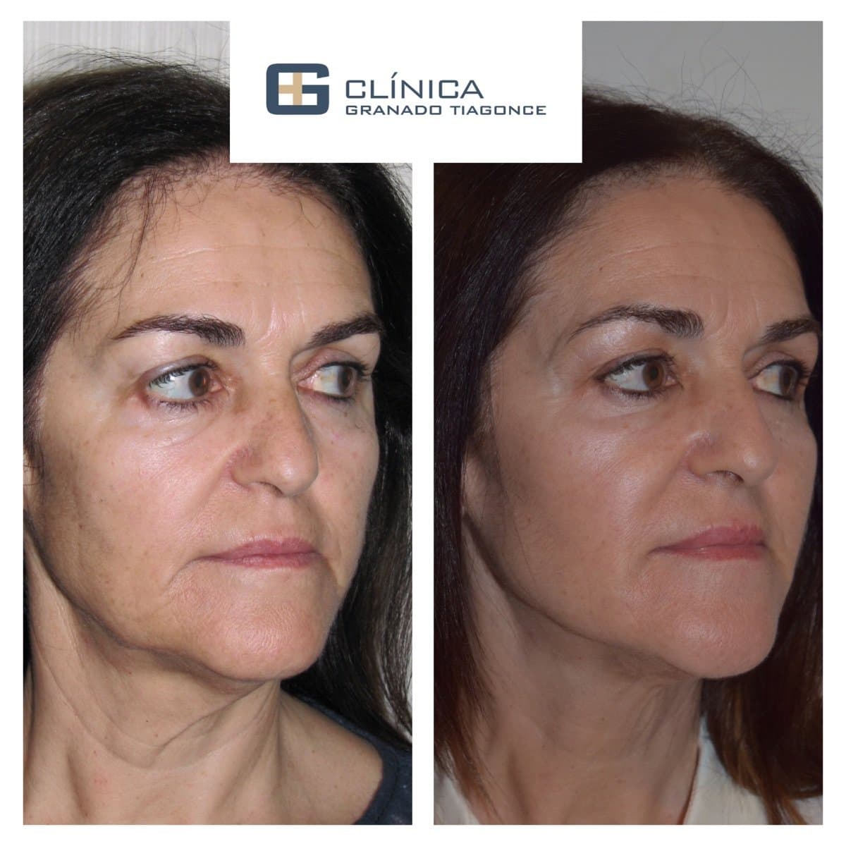fillers injection