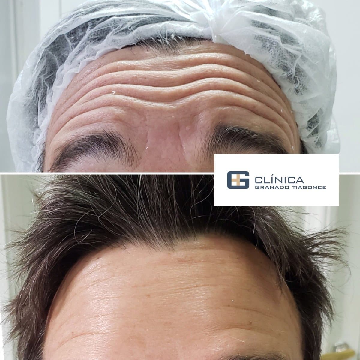 fillers injection
