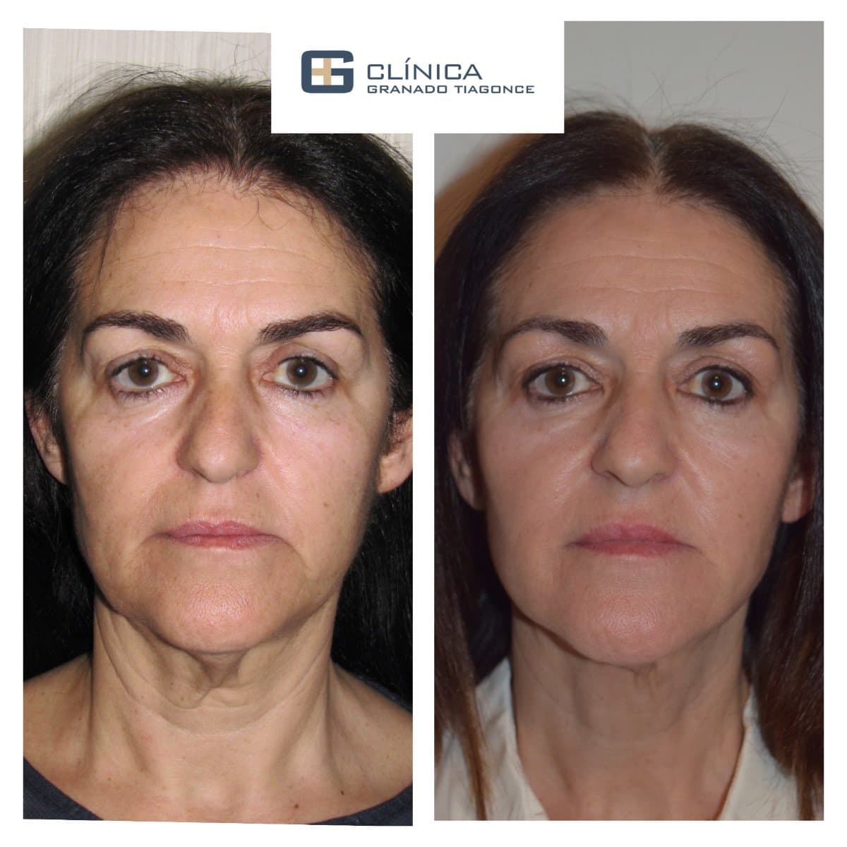 fillers injection