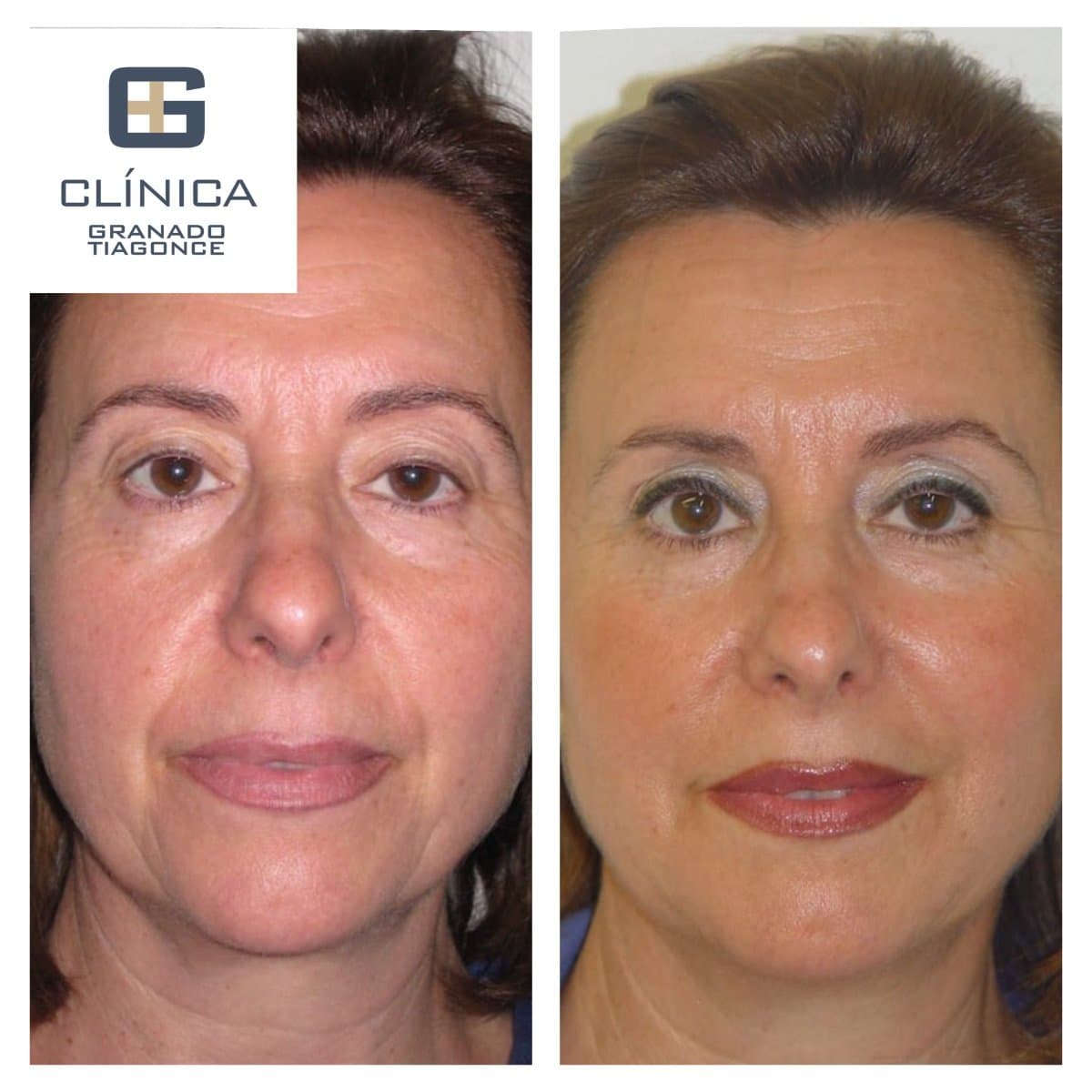 fillers injection