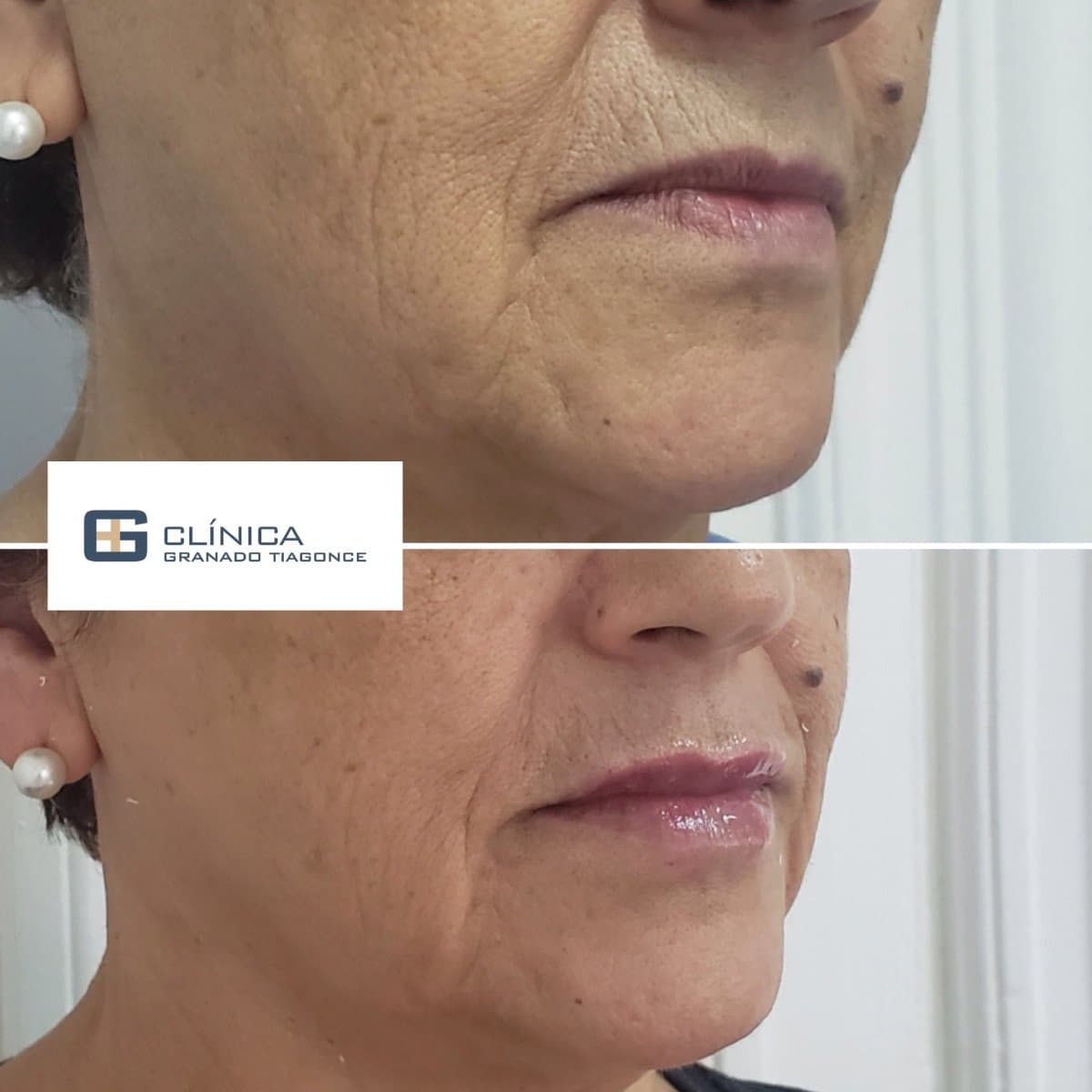 fillers injection