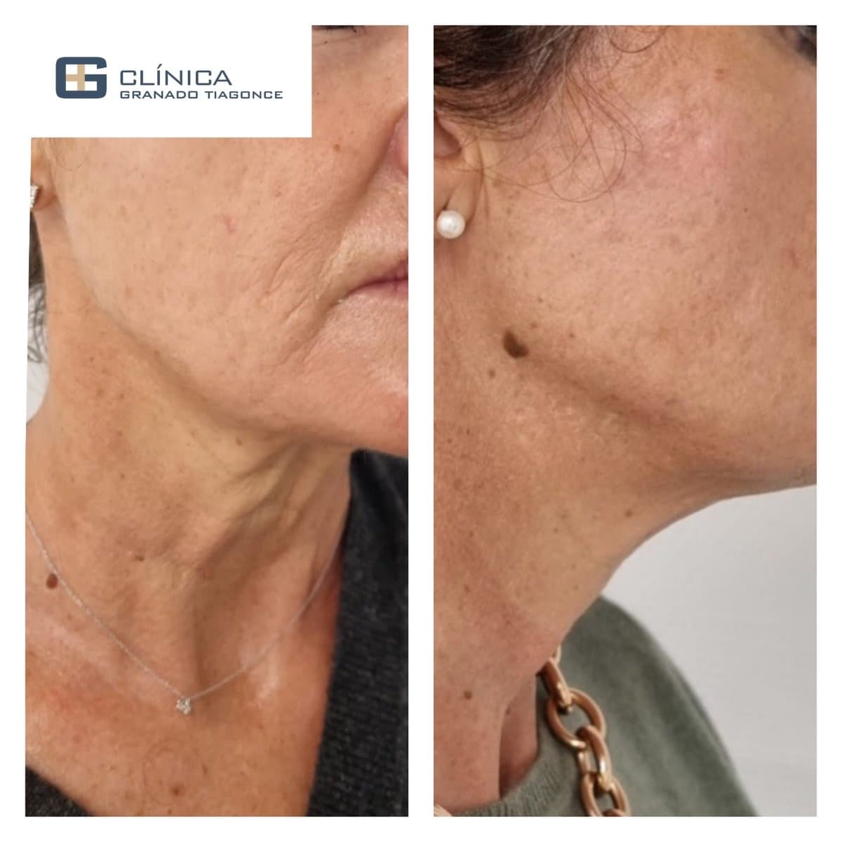 fillers injection