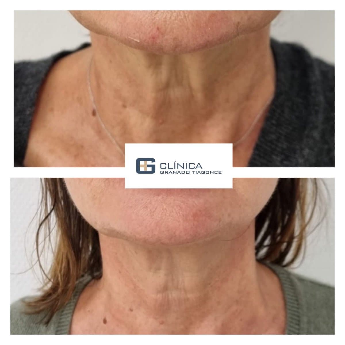 fillers injection
