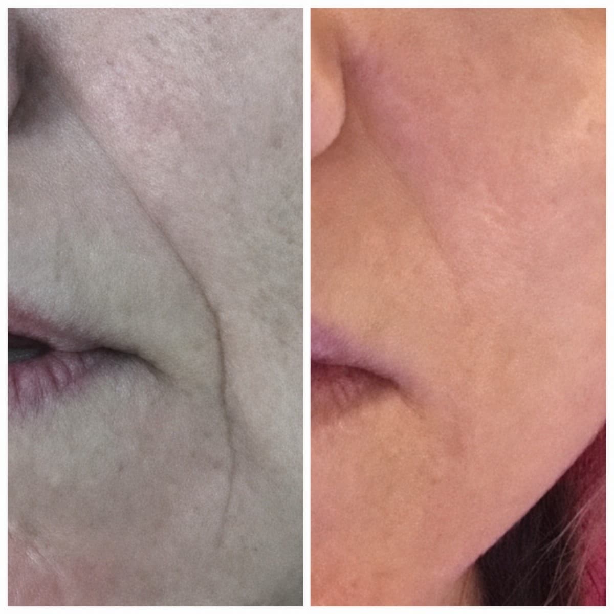 fillers injection