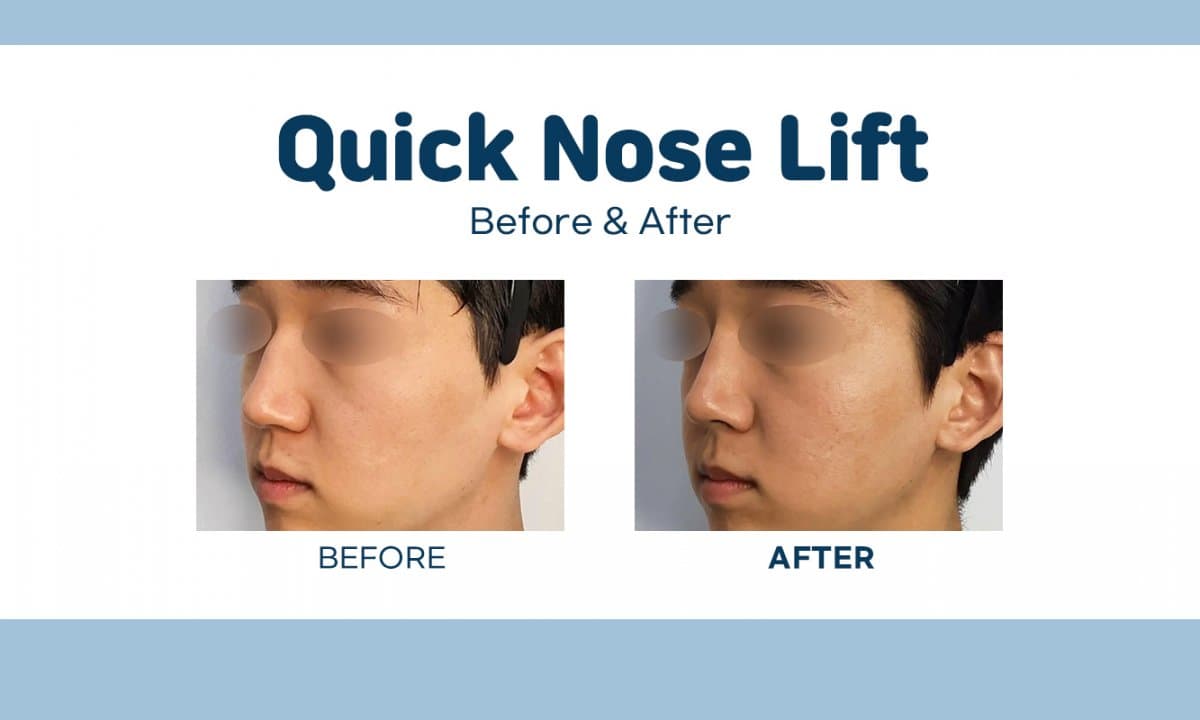 quick nose lift