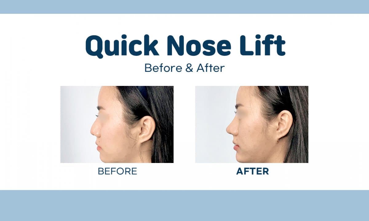 quick nose lift