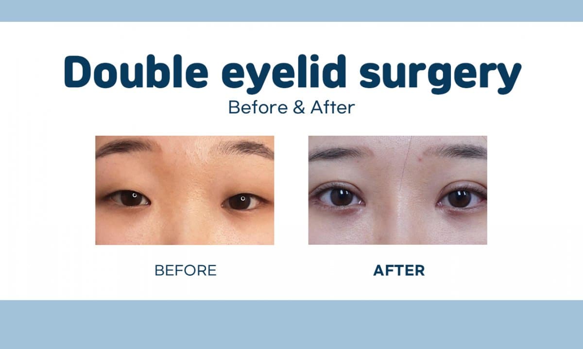 double eyelid surgery