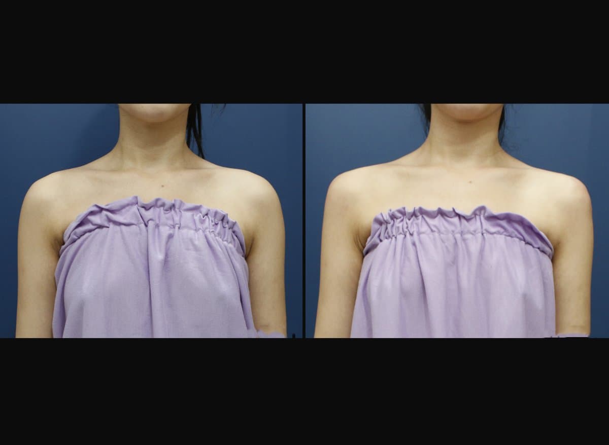 hyaluronic acid fillers for shoulder contour