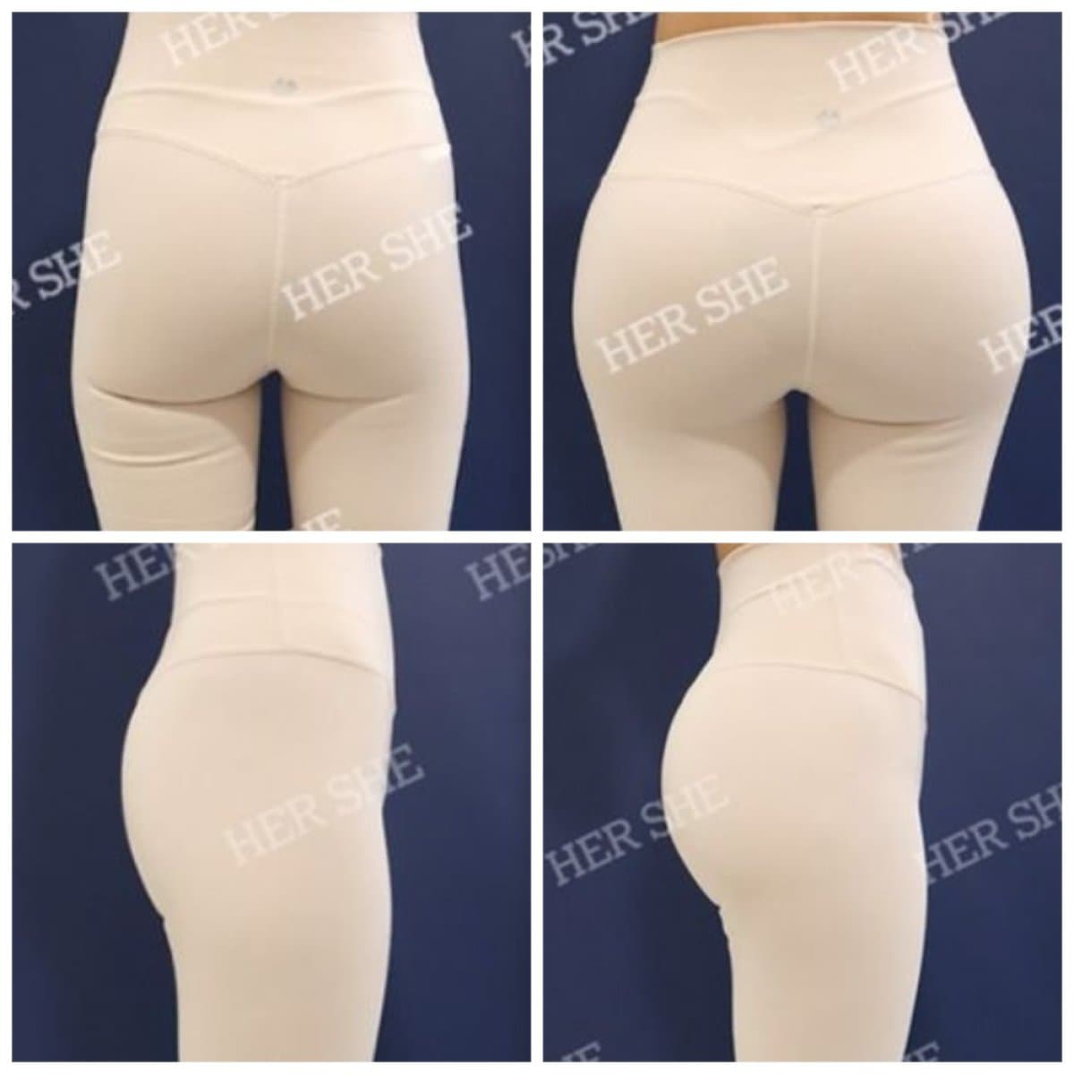 Brazilian Butt Lift