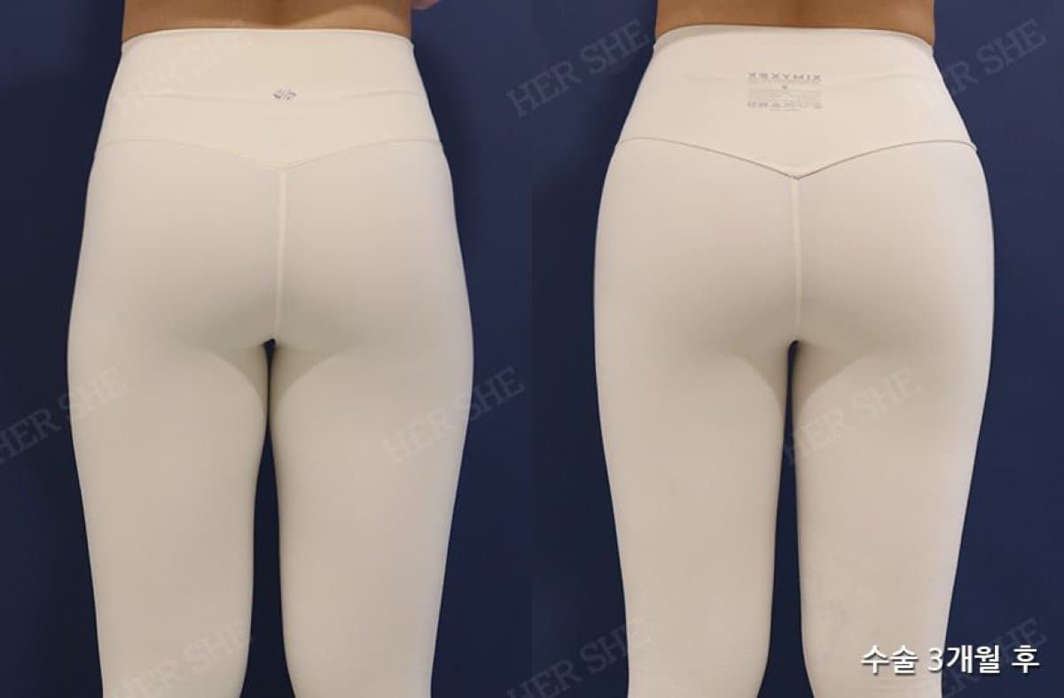 buttock lift