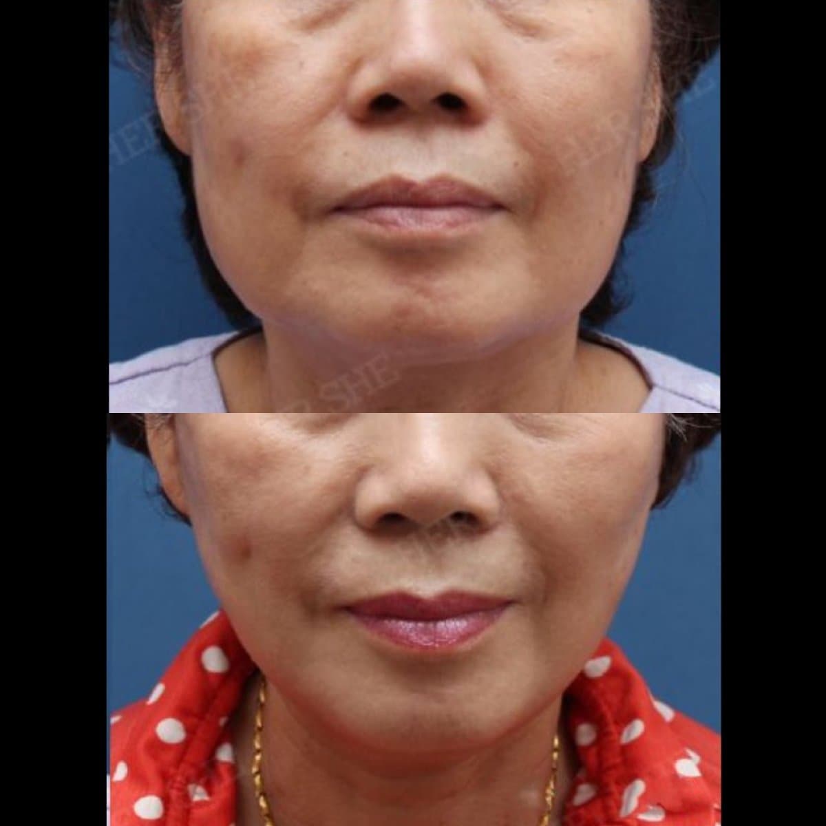 deep plane facelift