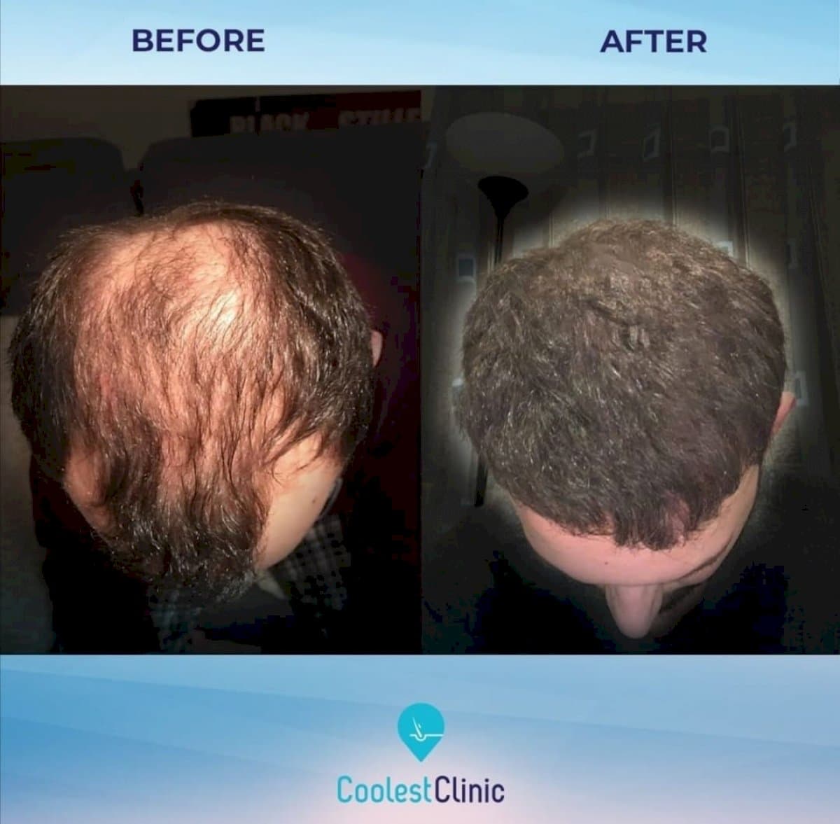 FUE hair transplant