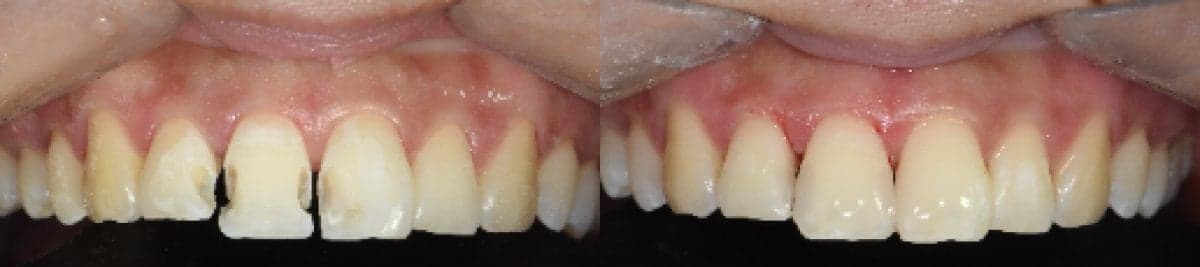inlay/onlay dental treatment