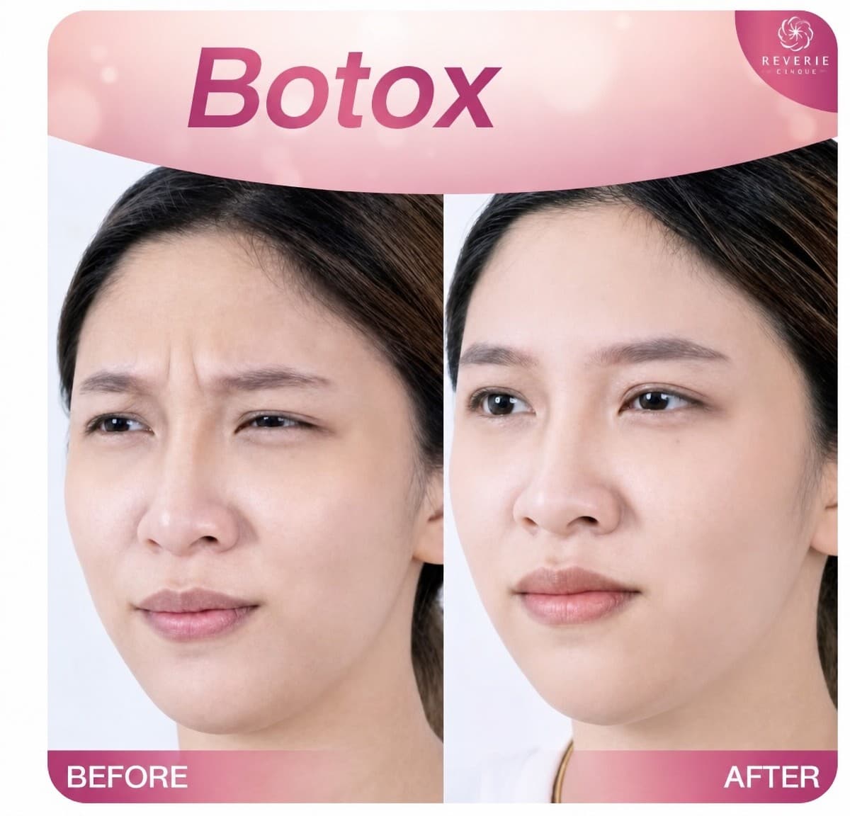 Botox wrinkle treatment
