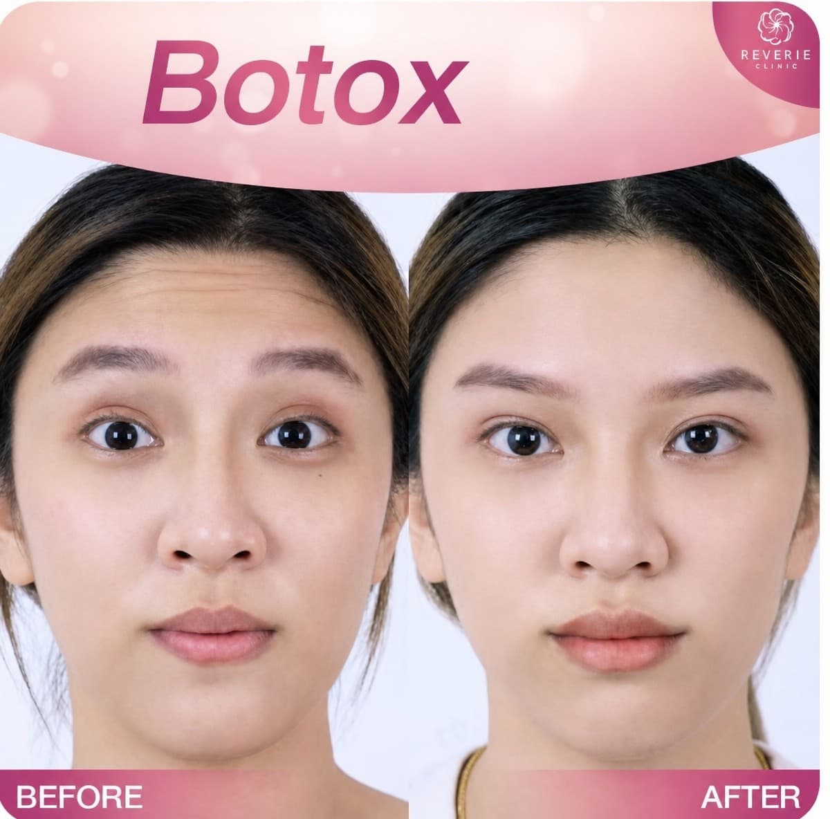 Botox wrinkle treatment