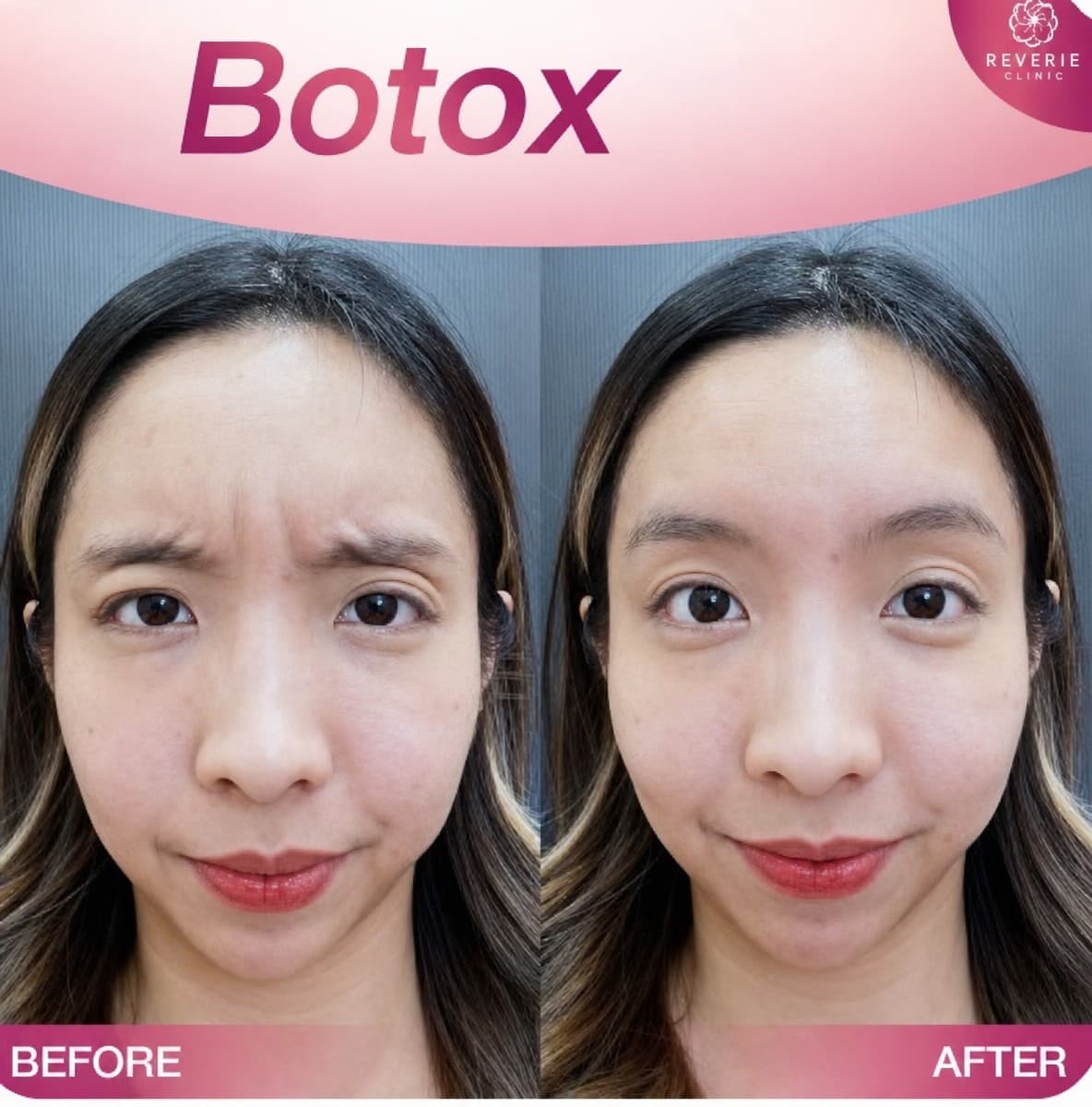 Botox wrinkle treatment