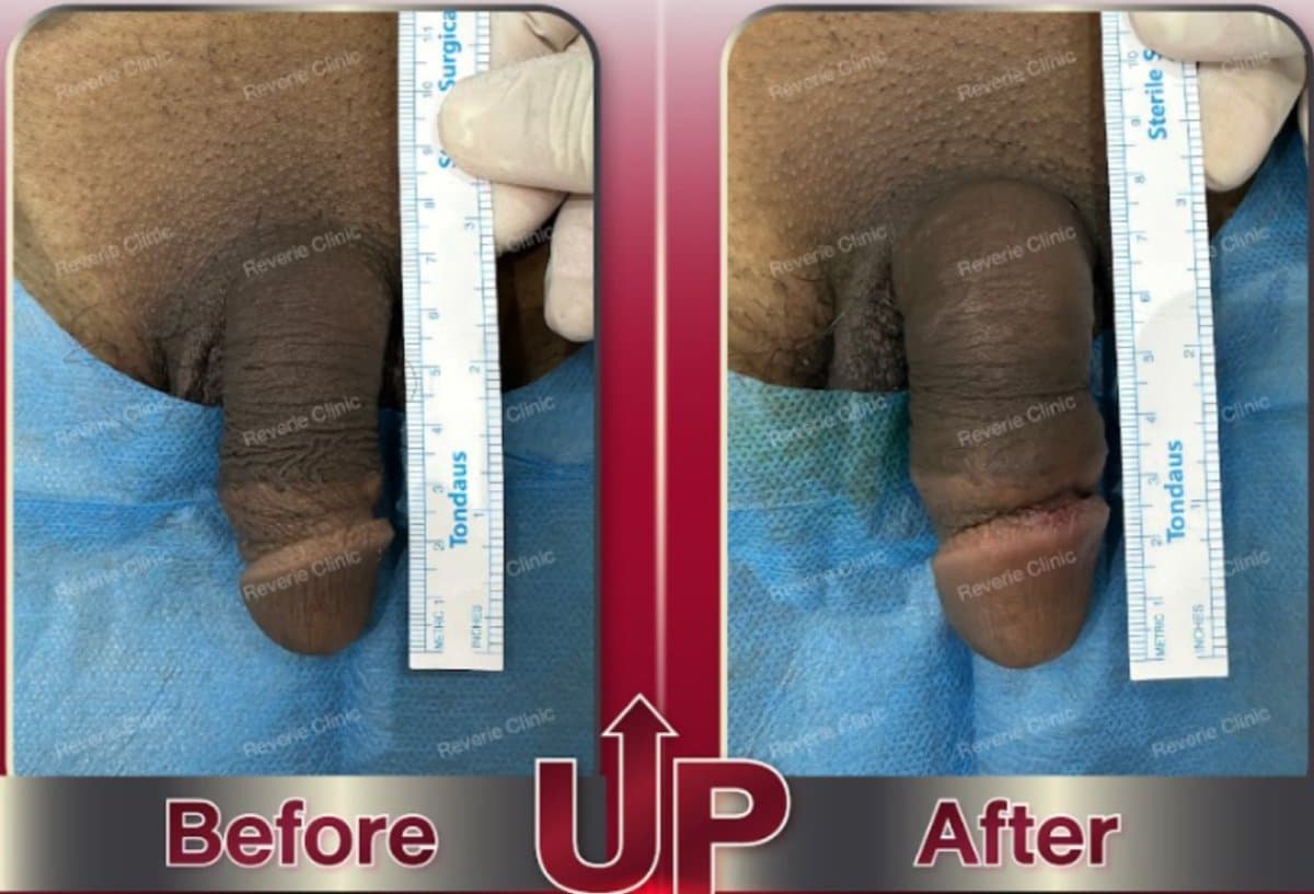 penis filler