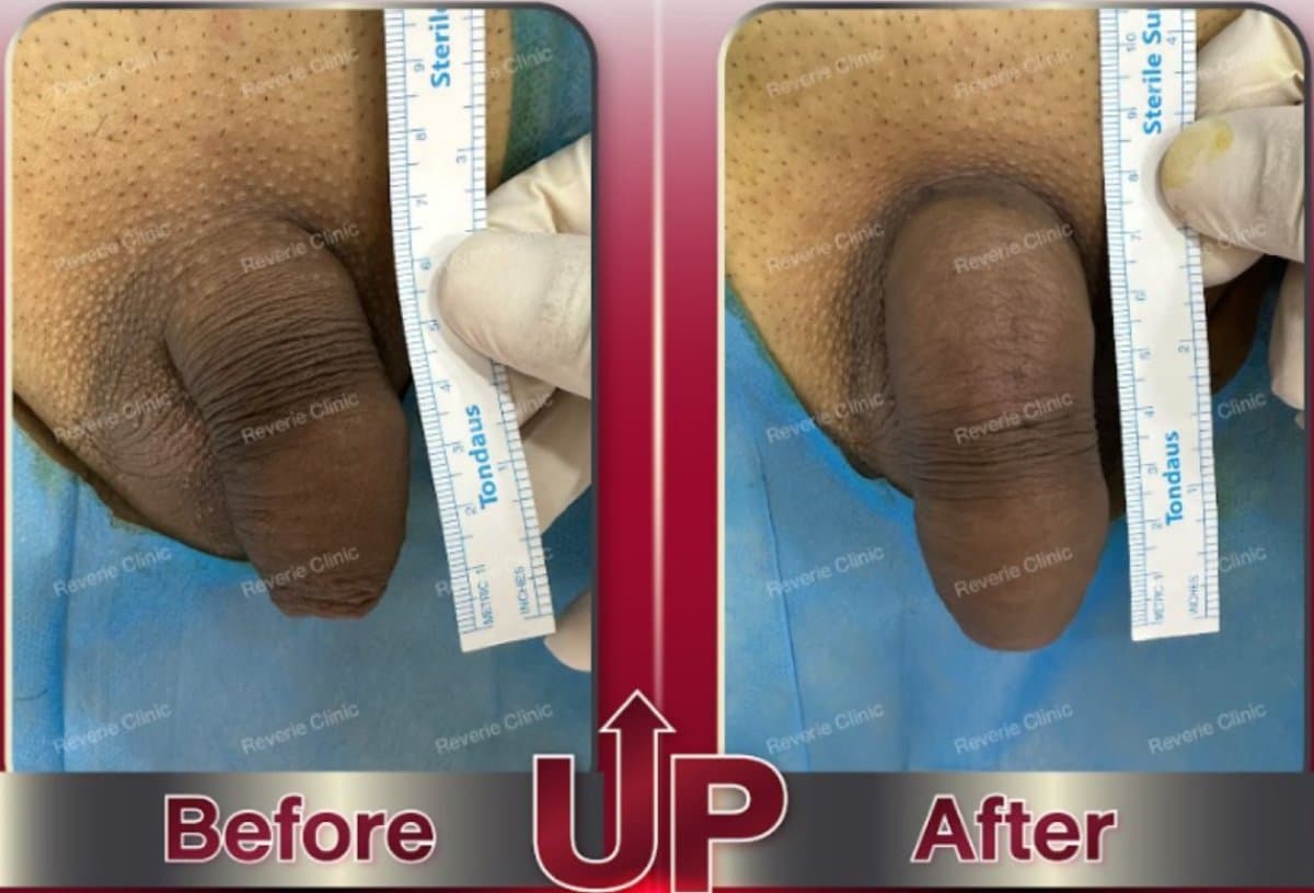 penis filler
