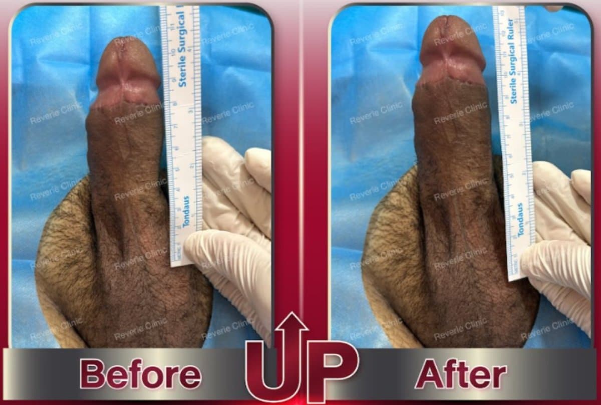 penis filler