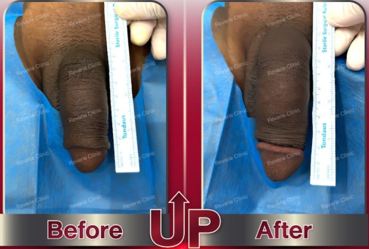 penis filler