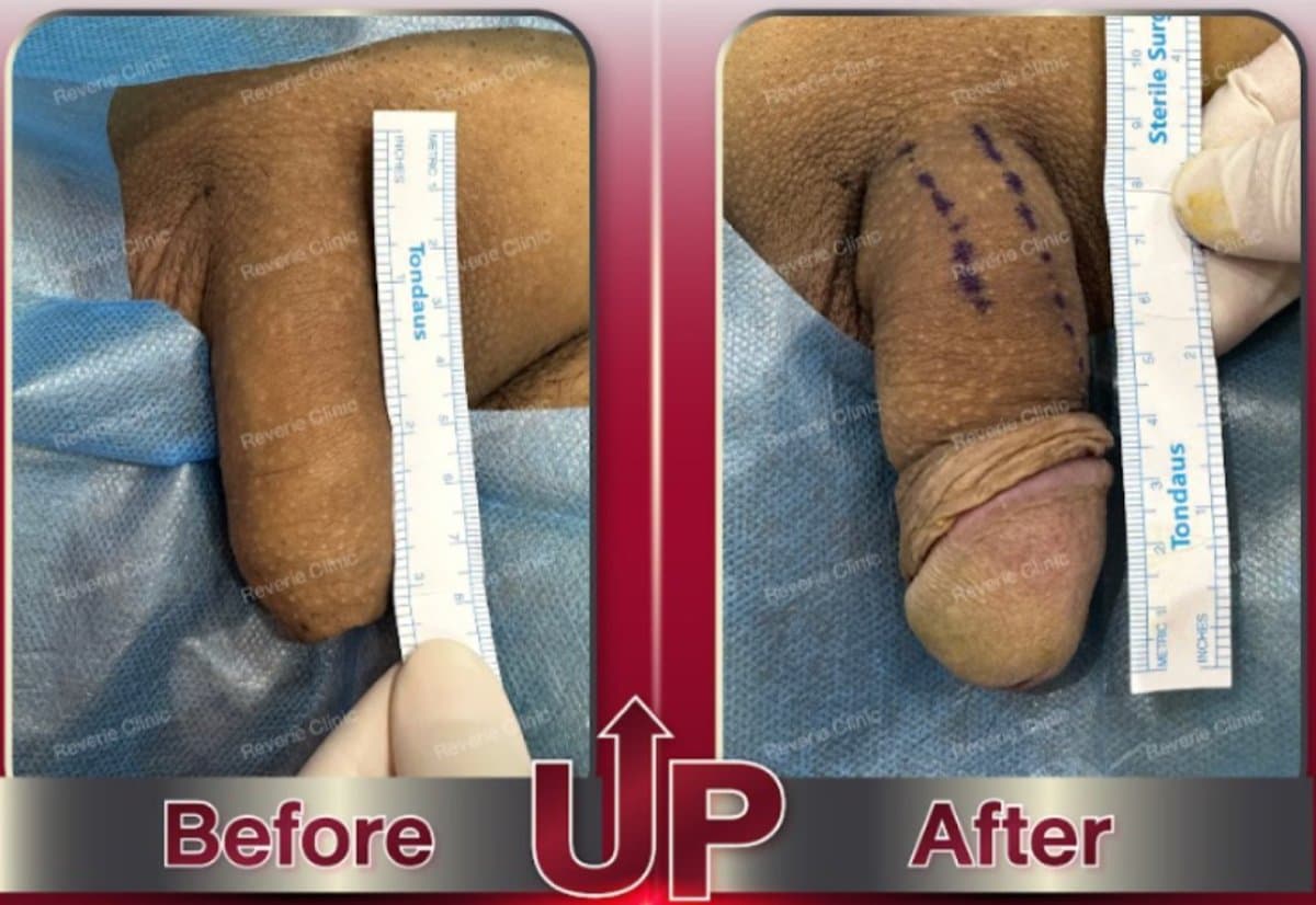 penis filler