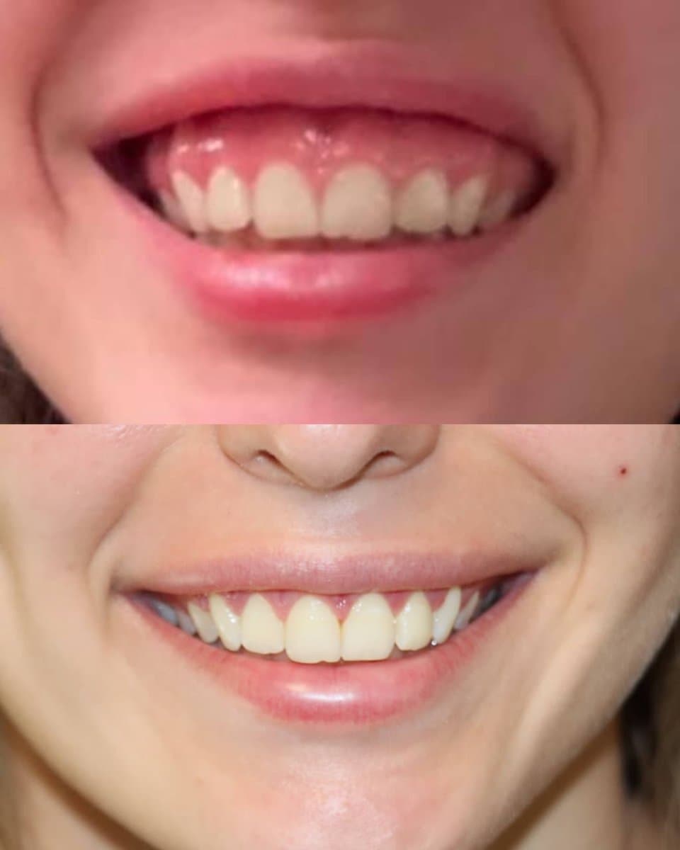 gum surgery