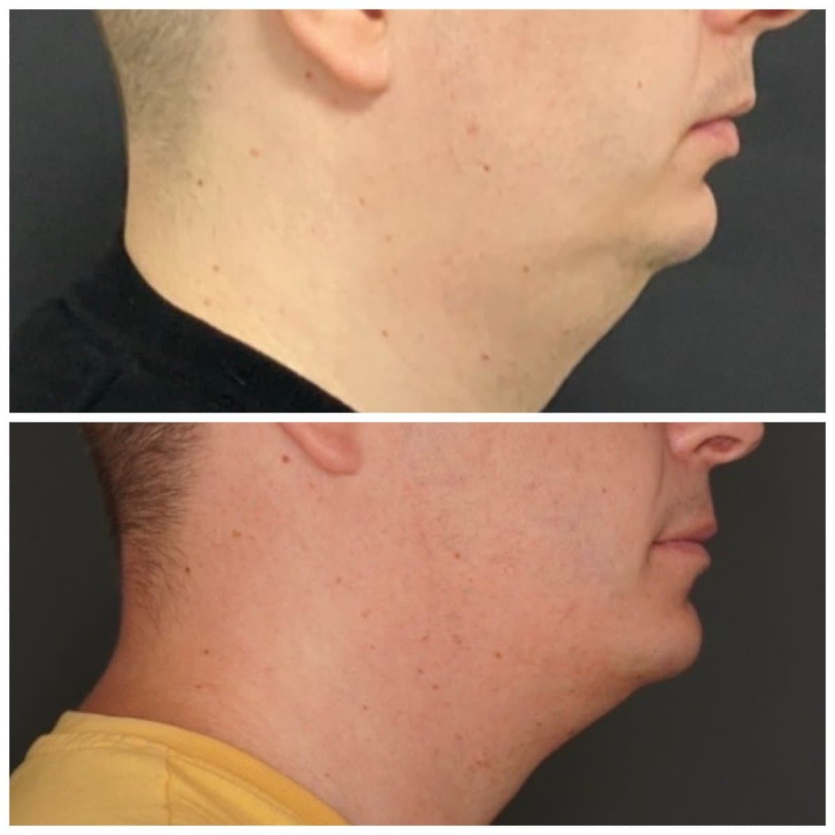 sliding genioplasty