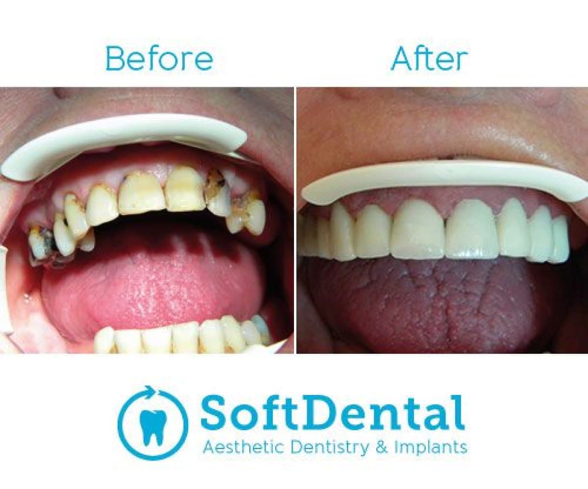 dental restoration