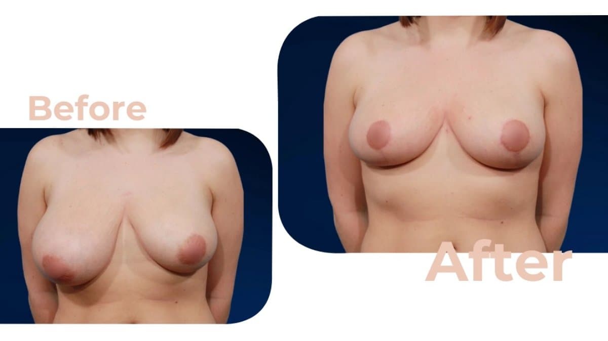 breast lift