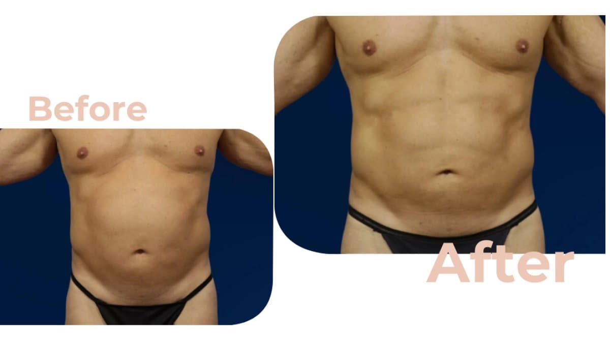 Vaser liposuction