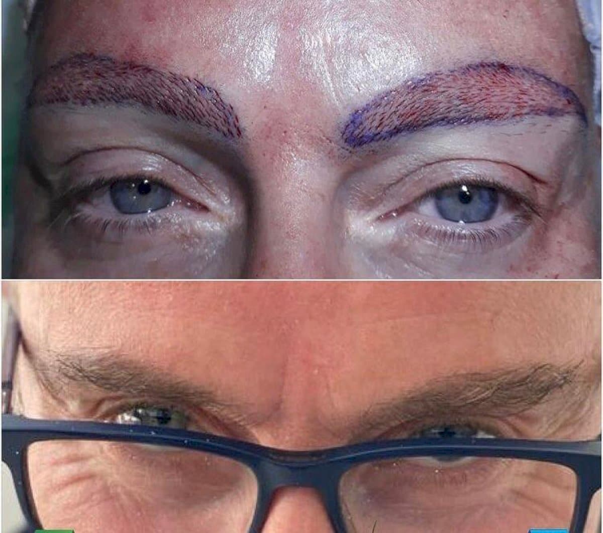 eyebrow transplantation