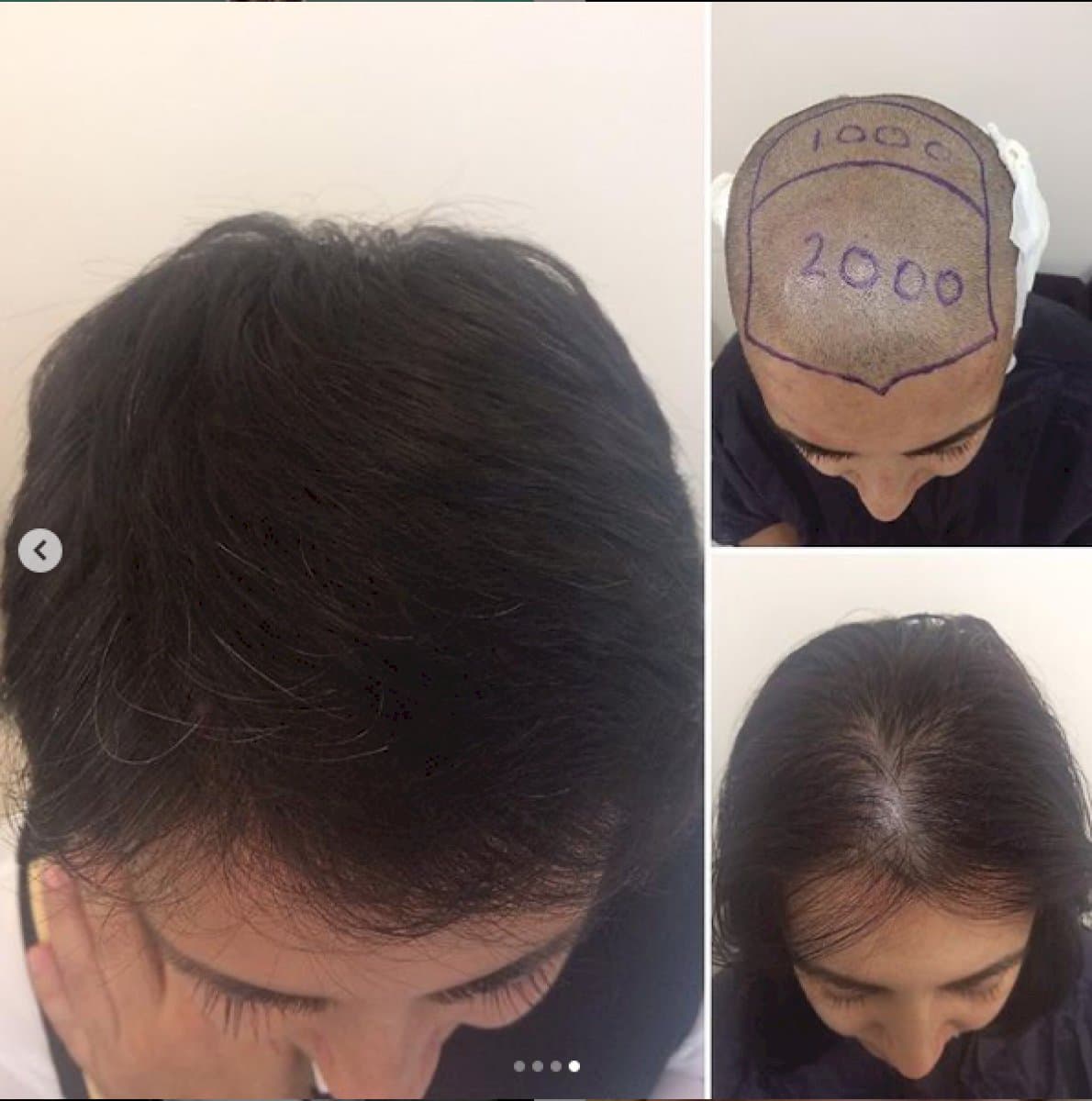hair transplant