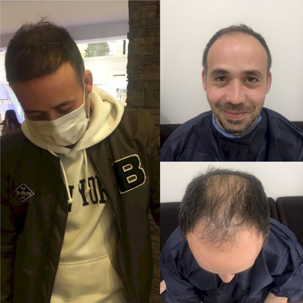 hair transplant