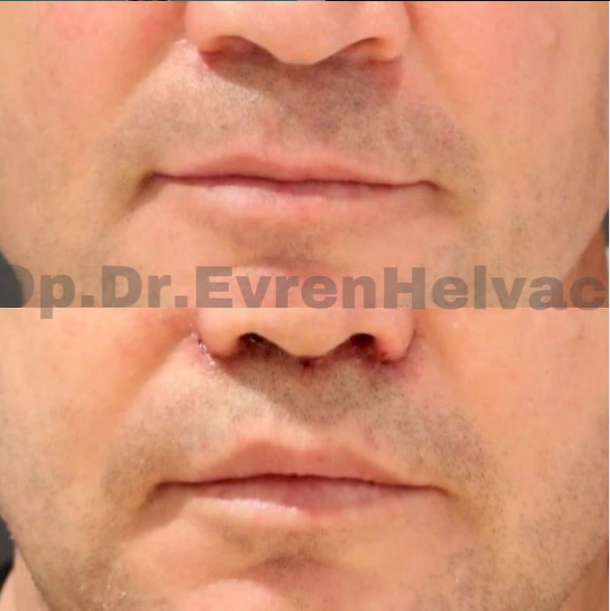 Botox injections