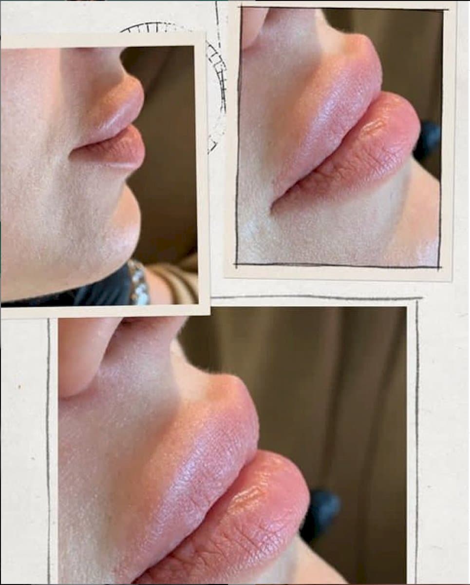 lip augmentation
