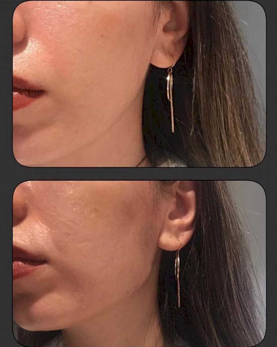 Botox injections