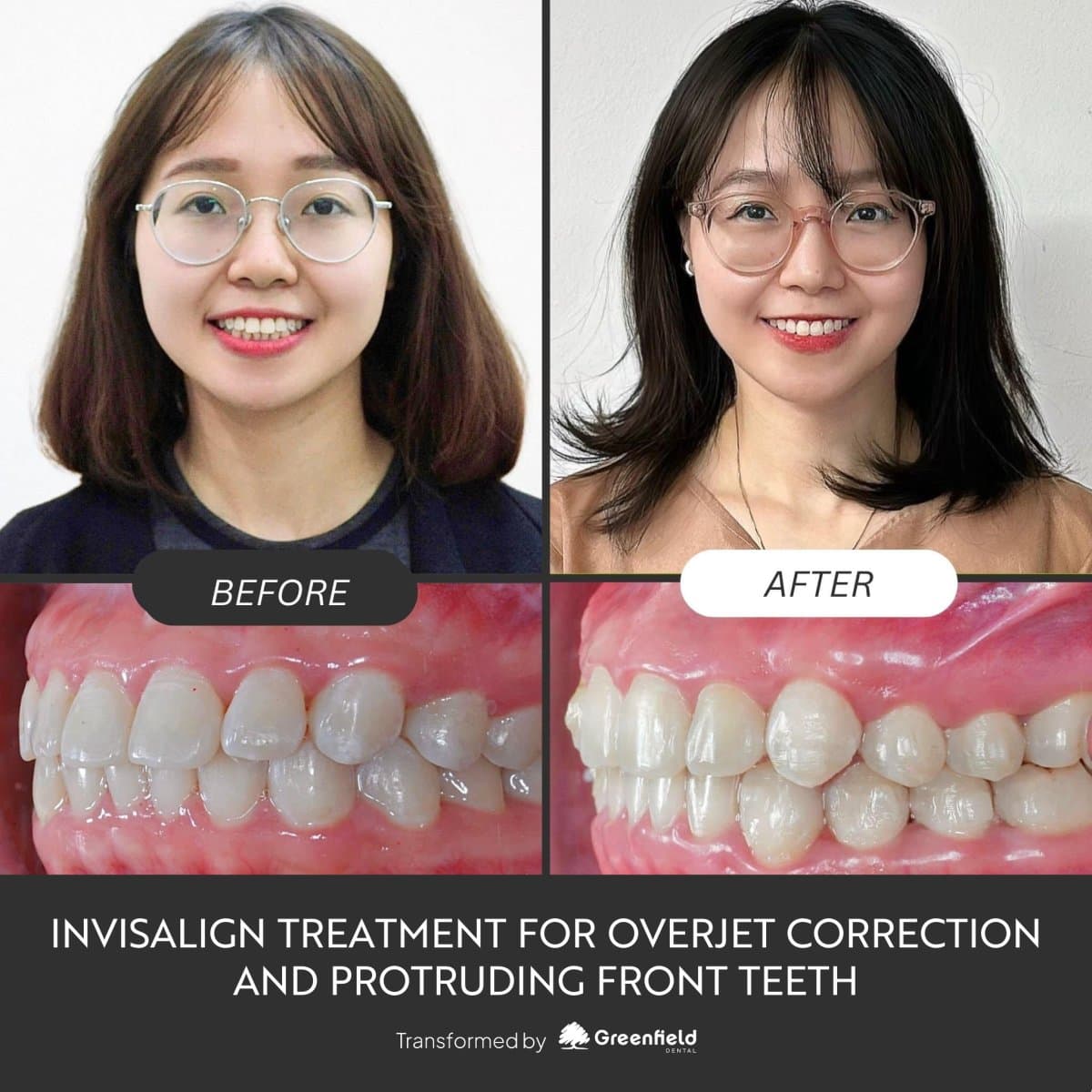 Invisalign for overjet correction
