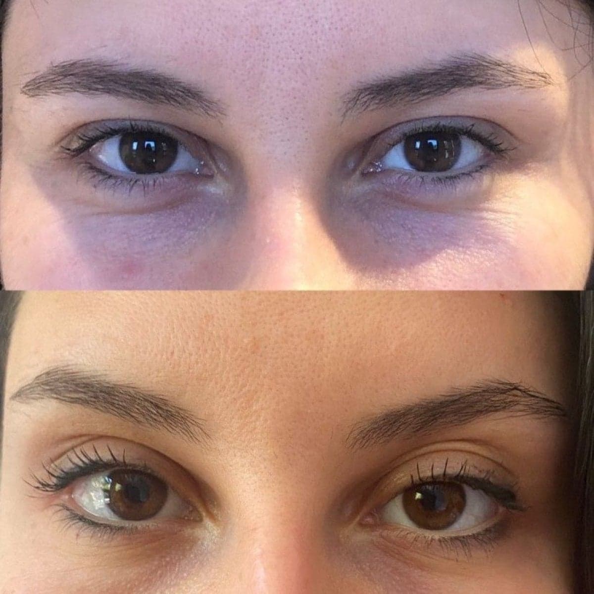 fillers injection