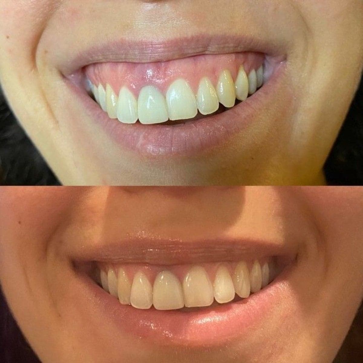 dental veneers