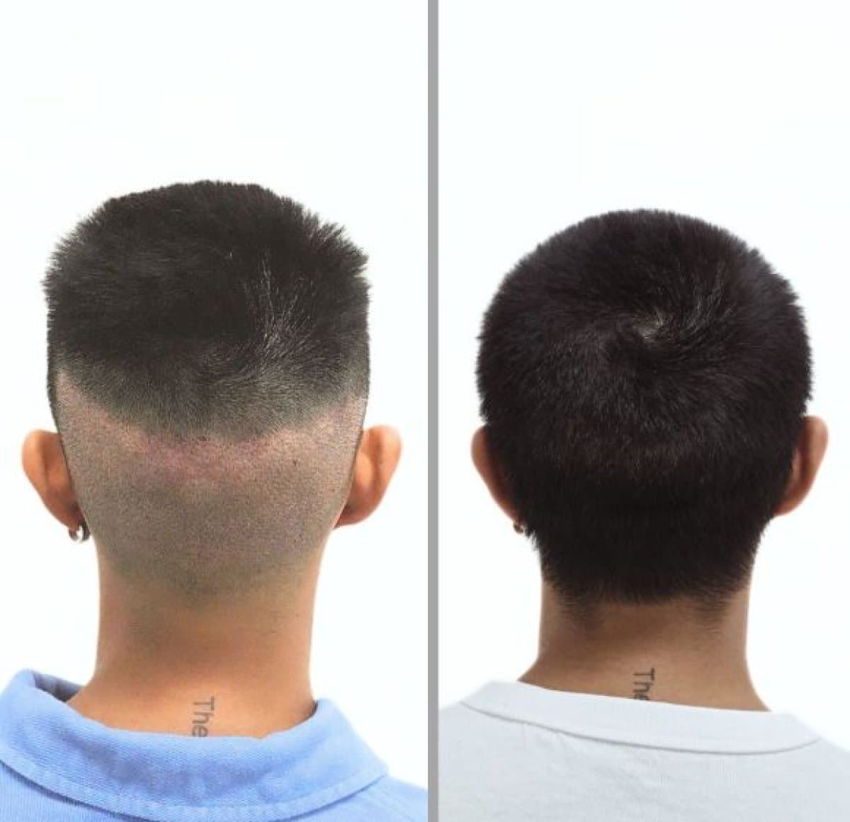 hair transplant