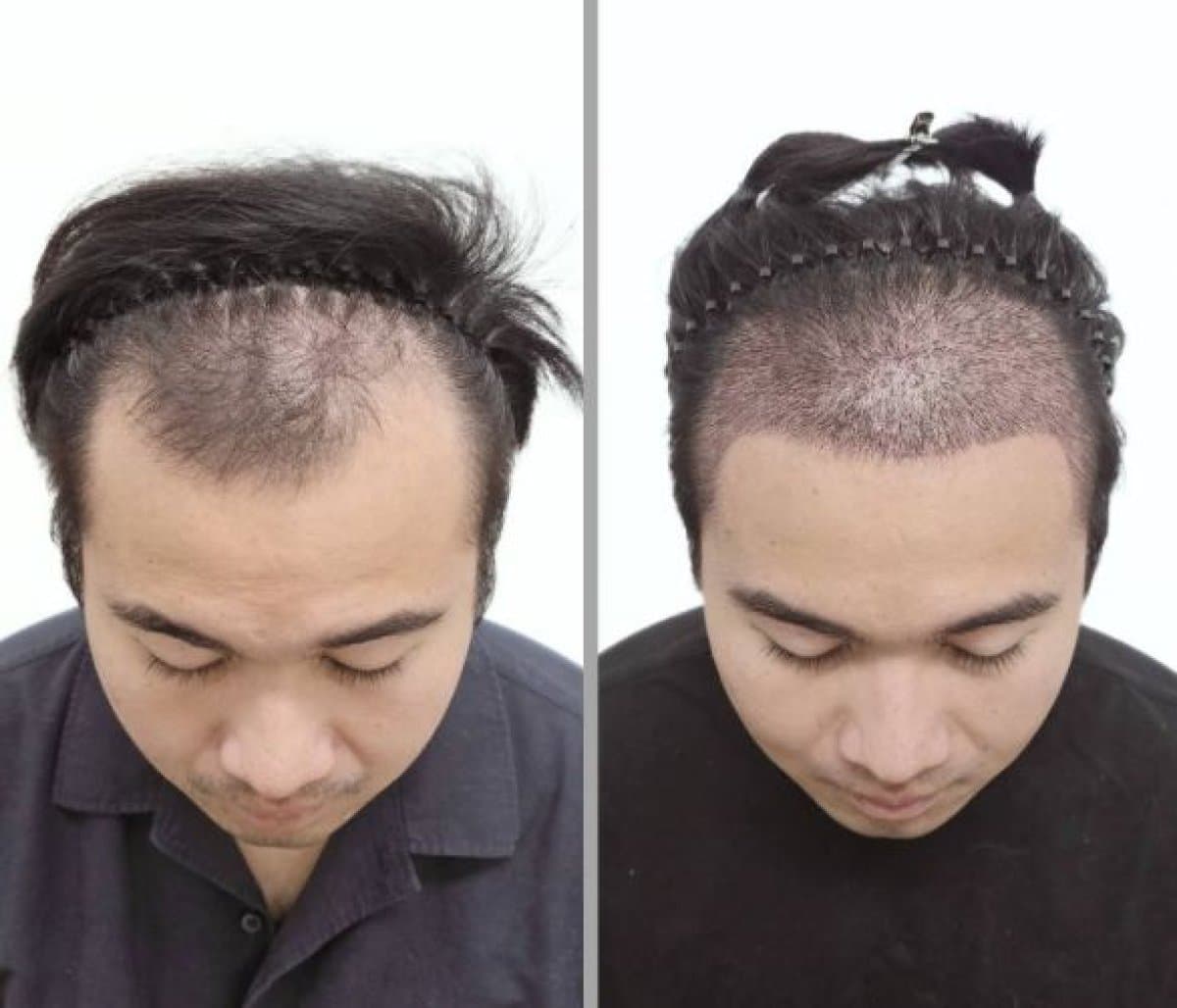hair transplant